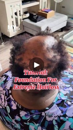 11K views · 2.7K reactions | ✅️Tutorial: Foundation For Extreme Hairloss.  Follow To See New Tutorials. Call or text 301-485-9298 . Traveling Stylist Serving All States. TRAVEL FEES DIFFER DEPENDING ON TRAVEL. 

💎Hairloss Consultations AVAILABLE. Comment "Consultation Now"

💥Crochet braids can be a protective style for hair loss because they provide low tension on the hairline and allow the natural hair to rest and grow without constant manipulation. Additionally, they offer versatility in styling while keeping the hair protected from environmental damage.

❗️Want to learn different braiding techniques?Subscribe To My Ig For $ 19.99.

❗️Did this help? Stay Tuned.❗️
Have Questions? 👇🏽Comment Below👇🏽 

 
❤️Like
👥️️Share
💬Comment 
⬇️Save

✨️I AM A LICENSED TRAVELING STYLIST SERVING TH Crochet Braids For Alopecia, Alopecia Cover Up Braids, Traction Alopecia Hairstyles, Frontal Fibrosing Alopecia Hair Pieces, Alopecia Hairstyles, Environmental Damage, Protective Styles, Foundation