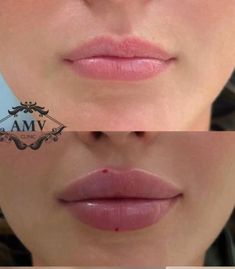 Lip Injections On Small Lips, Lip Filler Contour, Russian Lip Filler Aesthetic, Lip Filler No Cupids Bow, Big Lip Filler, M Shape Lip Filler, Lip Filler Examples, Rounded Lip Filler