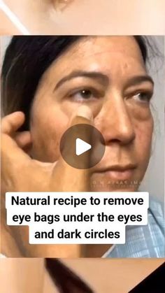 HealthTipssssss on Instagram: "NATURAL RECIPE TO REMOVE EYE BAGS UNDER remove  THE EYES AND DARK CIRCLES  Leve bags under the eyes  #darkcircles  #skin#naturalremedy circles  #womenshealth  #healthy#uganda#southafrica  #worldwide #naturalremedies" Undereye Bags Remedy, Eye Bag Remedies, Eye Health Remedies, Eye Bags Makeup, Puffy Eyes Remedy, Remove Eye Bags, Dark Eye Circles, Brown Spots Removal, Eye Exercises