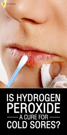 Is Hydrogen Peroxide A Cure For Cold Sores? Cold Sore Remedy Overnight, Cold Sore Lip, Hydrogen Peroxide Skin, Cold Sore Prevention, Get Rid Of Cold, Cold Sores, Canker Sore, Skin Natural Remedies, Cold Sores Remedies