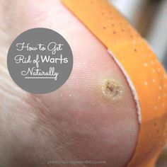 If you are wondering how to get rid of warts naturally, this post is for you. We have a frugal, all-natural cure that you probably have in your kitchen. Planter Warts Remedies, Seed Wart, Plantar Wart Remedies, How To Treat Warts, Plantar Wart Removal, Skin Tags Apple Cider Vinegar, Wart On Finger, Warts On Hands