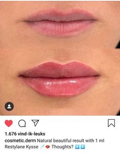 Restylane Kysse Lips Before And After, Julie Horne Lip Filler, Kysse Lips Filler Before And After, Lip Filler Inspo 1 Ml, Lip Filler Shape Ideas Natural, Natural Lip Fillers 1ml, Light Lip Filler, Half Syringe Lip Filler Before And After, Natural Lip Fillers 0.5ml