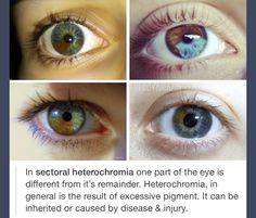 four different pictures of an eye with the caption'in sectional heropromia one part of the eye is different from it '