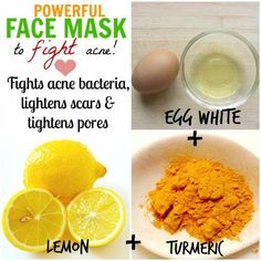 Discover powerful homemade face masks for acne control, cure and prevention. These remedies will help you tackle acne bacteria as well as acne scars, blemishes and large pores. Homemade Face Mask For Acne, How To Stop Pimples, Mask For Acne Prone Skin, Lemon Juice Face, Acne Remedy, Face Mask For Acne, Mask For Acne, Obličejové Masky, Homemade Face Mask