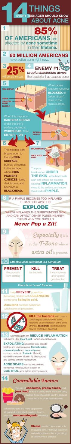 Great infographic for teens about acne What Are Blackheads, Effaclar Duo, Acne Treatments, Types Of Acne, Acne Problem, Acne Solutions, Acne Free, Acne Remedies, How To Get Rid Of Acne