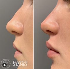 Nose Ideas, Nose Lift, Nose Fillers, Rhinoplasty Nose Jobs, Pretty Nose, Facial Fillers, Perfect Nose