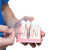 Every time you replace a tooth with a #dental implant, there are three parts involved: the implant, the implant abutment, and the fixed #restoration. Teeth Replacement, Implant Dentist, Denture Implants, Dental Implant Surgery, Dental Technician, Tooth Replacement, Missing Teeth