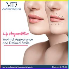 Lip augmentation can give you more than just a pretty pucker! It is a cosmetic procedure performed to improve the appearance of the lips by making them look fuller and plumper. Schedule an appointment with Lip augmentation specialist, Dr. Susan Lin by calling (650) 340-7546 Lip Augmentation, Small Lips, Enhance Your Beauty, Cosmetic Procedures, Plastic Surgery, Surgery, San Francisco, Lips, Map