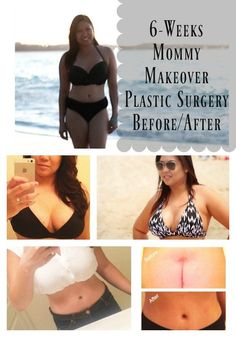 6 weeks post op mommy makeover plastic surgery before and after results. Post Op Mommy Makeover, Post Mommy Makeover Surgery, Mummy Makeover Surgery Before After, Mommy Makeover Recovery Tips, Mommy Makeover Must Haves, Mommy Makeover Before And After, Plastic Surgery Before And After Breast Augmentation, Breast Implant Before And After, Mommy Makeover Surgery Before And After Tummy Tucks