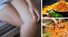 8 Ways To Get Rid Of Varicose Veins Naturally Benefits Of Witch Hazel, Varicose Vein Remedy, Cypress Oil, Cypress Essential Oil, Warm Compress, Lower Inflammation, Under The Knife, Turmeric Tea, Calf Raises