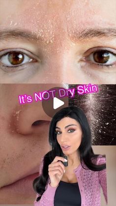 Achieve Radiant Skin with this 9-Step Simple Skincare Routine❤️ |Skincare & Beauty Tips Flaky Skin Remedy, Dry Forehead, Flaky Skin On Face, Dry Peeling Skin, Super Dry Skin, Facial For Dry Skin, Scale Skin, Flaking Skin, Extremely Dry Skin