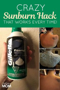 Texas Mom's Unusual Sunburn Hack Goes Viral—Because it Works Sunburn On Face, How To Help Sunburn, Home Remedies For Sunburn, Severe Sunburn, Get Rid Of Sunburn, Burn Remedy, Heal Sunburn, Natural Remedies For Sunburn, Burn Relief