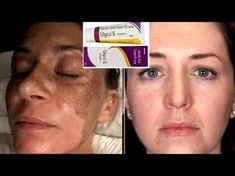 Glycolic Acid How To Use, Pigmentation On Face, Hyperpigmentation Remedies, Glycolic Acid Cream, Clean Skin Face, Get Rid Of Pimples, Rid Of Pimples, Fairness Cream, Chemical Exfoliation