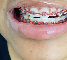 Perfect Teeth Braces, Power Chain Braces, Red Braces, Cute Braces Colors, Teeth Aesthetic, Black Hair Green Eyes, Braces Tips