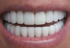 Natural Teeth Whitening Diy, Teeth Whiting At Home, Get Whiter Teeth, Teeth Dentist, Teeth Whitening Diy, Beautiful Teeth, Teeth Bleaching, Pasta Dental, Perfect Teeth