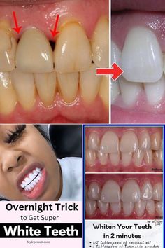 Teeth Whiting At Home, Natural Teeth Whitening, Teeth Whitening, Gum