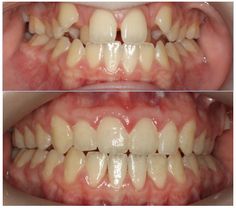 Before And After Braces, Teeth Reference, Braces Before And After, After Braces, Invisalign Braces, Dental Braces, Orthodontics Braces, Perfect Teeth, Natural Teeth