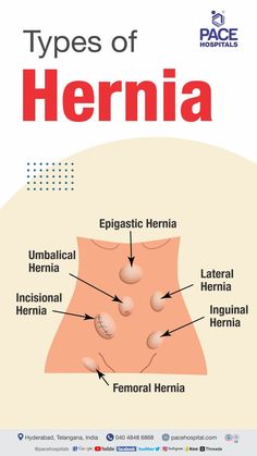 Hernia Types Chronic Cough, Laparoscopic Surgery, Lungs Health, Medical School Inspiration, Human Body Systems, Medical School Studying, Parts Of The Body, Body Systems, Abdominal Muscles