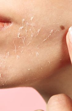 What it is: A bioactive peeling gel that exfoliates skin without using abrasive ingredients to improve the appearance of skin's texture. Remove Skin Tags Naturally, Cold Sores Remedies, Facial Peel, Natural Sleep Remedies, Natural Cold Remedies, Natural Cough Remedies, Body Hair Removal, How To Exfoliate Skin, Lose 40 Pounds