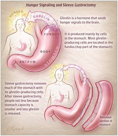 Sleeve Gastrectomy for Weight Loss  JAMA. 2018;319(3):316. doi:10.1001/jama.2017.18519 Gastric Bypass Journal, Fibroid Surgery, Stomach Sleeve, Sleeve Gastric, Gastric Bypass Sleeve, Preparing For Gastric Surgery, Gastric Problem, Laparoscopic Surgery