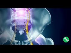 Sciatica VS Piriformis Syndrome: How to Relieve Lower Back Pain - Health... Hip Surgery Recovery, Sciatica Symptoms, Sciatica Exercises, Piriformis Syndrome, Sciatica Relief, Hip Surgery, Sciatic Nerve Pain, Sciatica Pain, Relieve Back Pain