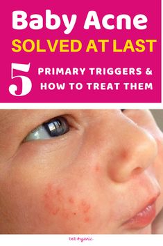 BABY ACNE IS CAUSED BY ONE OR A COMBINATION OF 6 PRIMARY TRIGGERS ON THE SKIN SURFACE! It was previously considered either untreatable or not worth treating by doctors, but scientific advancements and a deeper understanding of skin have resulted in an update by pediatric dermatologists. Acne Causes, Good Riddance, Sleeping Through The Night, Baby Kit, When I Grow Up, Breast Milk, At Last, Primary School