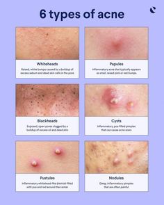 Nodule Acne, Acne Types, Different Types Of Acne, Forehead Acne, Pimples Under The Skin, Natural Acne Remedies, Types Of Acne, Basic Skin Care Routine, Perfect Skin Care Routine