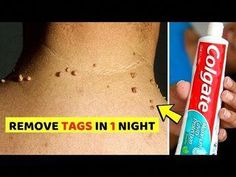 Apply this remedy overnight and remove tags from your neck, face or even eyelids. This is the world's best home remedy that I have found for the treatment of... Home Remedies For Skin, Tag Remover, Bloated Belly