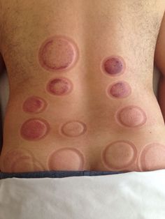 Cupping of the lower back for sciatica low back pain Sciatica Massage, Sciatic Nerve Relief, Hijama Cupping, Therapy Benefits, Acupuncture Benefits, Severe Back Pain, Massage For Men, Sciatica Relief, Back Pain Remedies