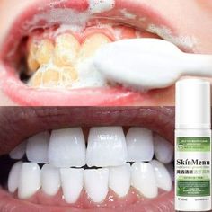 Pressing Type Mousse Toothpaste Foam, Whitening Toothpaste Ultra-fine Mousse Foam, Deep Cleaning Gums Fresh Teeth Whitening Oral Hygiene Removes Plaque Stains Description: 1.Ingredients: Tea extract, peppermint extract, ascorbic acid (vitamin C). 2.360-degree care of the oral cavity, mild and non-irritating, care for the gums, bright teeth. 3.Plant extracts, help to break down the pigmentation on the surface of the teeth, block pigmentation, keep the teeth bright and white. 4.Green tea taste, ca Baking Soda Teeth, Baking Soda Toothpaste, Baking Soda Teeth Whitening, Plaque Teeth, Teeth Whitening Homemade, Teeth Whitening Remedies, Tooth Whitening, Teeth Whitening Diy, Teeth Health