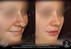 Nose Surgery Rhinoplasty, Bulbous Nose, Plastic Surgery Fail, Rhinoplasty Nose Jobs, Face Surgery, Rhinoplasty Before And After, Plastic Surgery Gone Wrong, Job Inspiration, Straight Nose