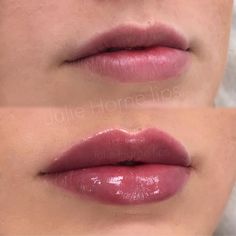 Restylane Lips, Aesthetics Nurse, Fillers Aesthetic, Diy Lip Plumper, Estilo Madison Beer, Nurse Injector, Permanent Lipstick