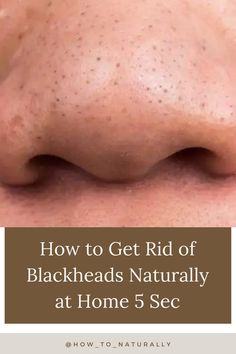 How do you get rid of blackheads on your nose #Health #HealthCare Whiteheads On Nose, Remedies For Blackheads, Natural Cold Sore Remedy, Underarm Smell, Get Rid Of Cold, For Blackheads, Blackhead Remedies, Smooth Glowing Skin, Blackheads On Nose