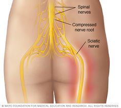 Can endometriosis affect the sciatic region? Yes. Read on! Sciatica Symptoms, Sciatic Nerve Pain, Sciatic Nerve, Leg Pain, Nerve Pain, Low Back Pain, Sciatica, Massage Therapy