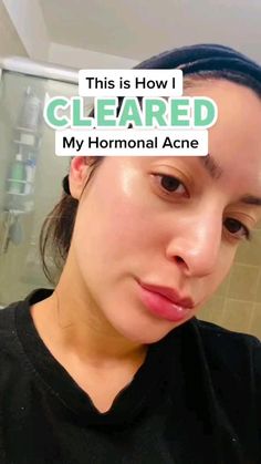 Clear Hormonal Acne, Closed Comedones, Skin Blackheads, Acne Hacks, Acne Routine, Clear Skin Diet, Acne Diet, Face Tips