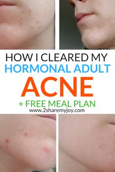 Acne Meal Plan, Get Rid Of Acne, Rid Of Acne