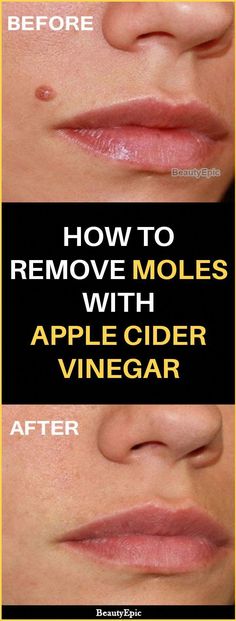 How To Remove Moles, Remove Moles, Skin Moles, Mole Removal, Skin Tags, Cold Sores Remedies, Natural Sleep Remedies, Natural Cold Remedies, Cold Home Remedies