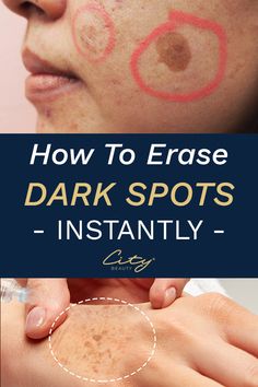 How To Fade, Dark Spots On Face, Brown Spots Removal, Dark Spots On Skin, Spots On Face, Saggy Skin, Face Wrinkles, Remove Dark Spots