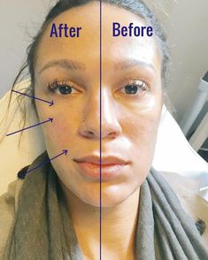 Face Symmetry Fillers, Under Eye Botox Before And After, Botox Under Eyes Before And After, Face Symmetry, Undereye Bags, Liquid Facelift, Botox Brow Lift, Yoga Face, Forehead Lift