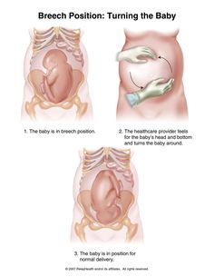 the stages of breast position during the baby's birth, and how it works