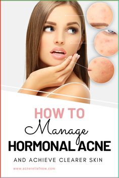 How to manage hormonal acne -Learn what causes hormonal acne, hormonal acne tips and learn natural treatment for hormonal acne. Click pin to achieve clearer skin today. Get Rid Of Keloids, Jawline Acne, Back Female, Acne Tips, Home Remedies For Acne, Types Of Acne, Acne Scar Removal, Clear Skin Tips, Hormonal Acne