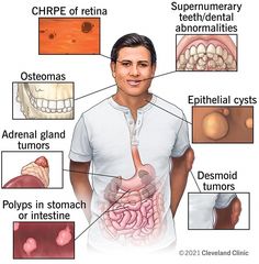 Gardner syndrome is a rare inherited disorder. People with Gardner syndrome typically develop hundreds of colon polyps that often become colon cancer. Bells Palsy, Fat Burning Tea, Genetic Disorders, Simple Health, Adrenal Glands, Cleveland Clinic, Support People, Med School, Mental And Emotional Health