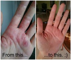 I suffered from dishydrotic eczema on my left hand for over a year, where nothing I applied on my skin could break the cycle of itching, scratching and bleeding. This is the earliest photo I have of my left hand which began developing over a year ago. It started just at the tip of my pointer, but with every round of it Dyshidrosis Remedies, Exzéma Home Remedies, Exema Treatments Natural, Exema Treatments, Ezcema Diet, Healthy Legs, Break The Cycle, Skin Remedies