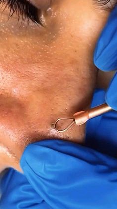 Satisfying Pimple Pops, Oddly Satisfying Videos Blackheads, Dr Pimple Poppìng Videos, Oddly Satisfying Videos Pimples, Leg Pimples, Cysts Popping Videos, Pimple Poppìng Videos Satisfying, Pimple Poppìng Videos, Satisfying Black Head Removal Video