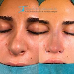 Bulbous Tip Rhinoplasty, Nose Front View, Tip Rhinoplasty, Face Fillers, Job Inspiration, Pretty Nose