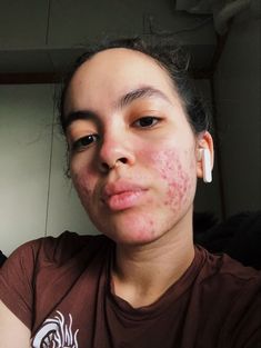 Girl With Acne Aesthetic, Acne Acceptance, Pretty Insecurities, Acne Appreciation