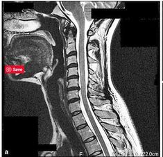 Fibermyalgia Symptoms, Brain And Spinal Cord, Forward Head Posture Exercises, Occipital Neuralgia, Spinal Fluid, Forward Head Posture, Spinal Surgery, Neck Surgery, Spinal Injury