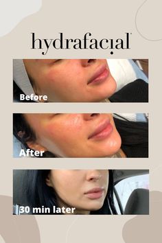 Hydrafacial Before And After Skin Care, Hydro Facial Before And After, Hydra Facial Before And After, Hydrafacial Post, Hydrafacial Videos, Hydrafacial Aesthetic, Hydrafacial Marketing, Hydrafacial Before And After, Facial Before And After