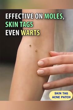 #ItchyBumpsOnMySkin Acne Patch, Skin Tags, Cold Sores Remedies, Natural Sleep Remedies, Natural Cold Remedies