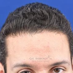 | HAIRLINE LOWERING SURGERY